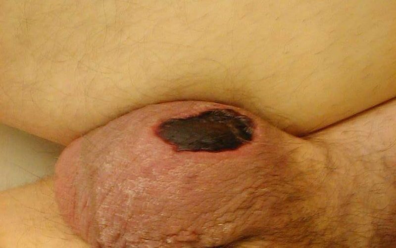 Fournier's Gangrene SimpleMed