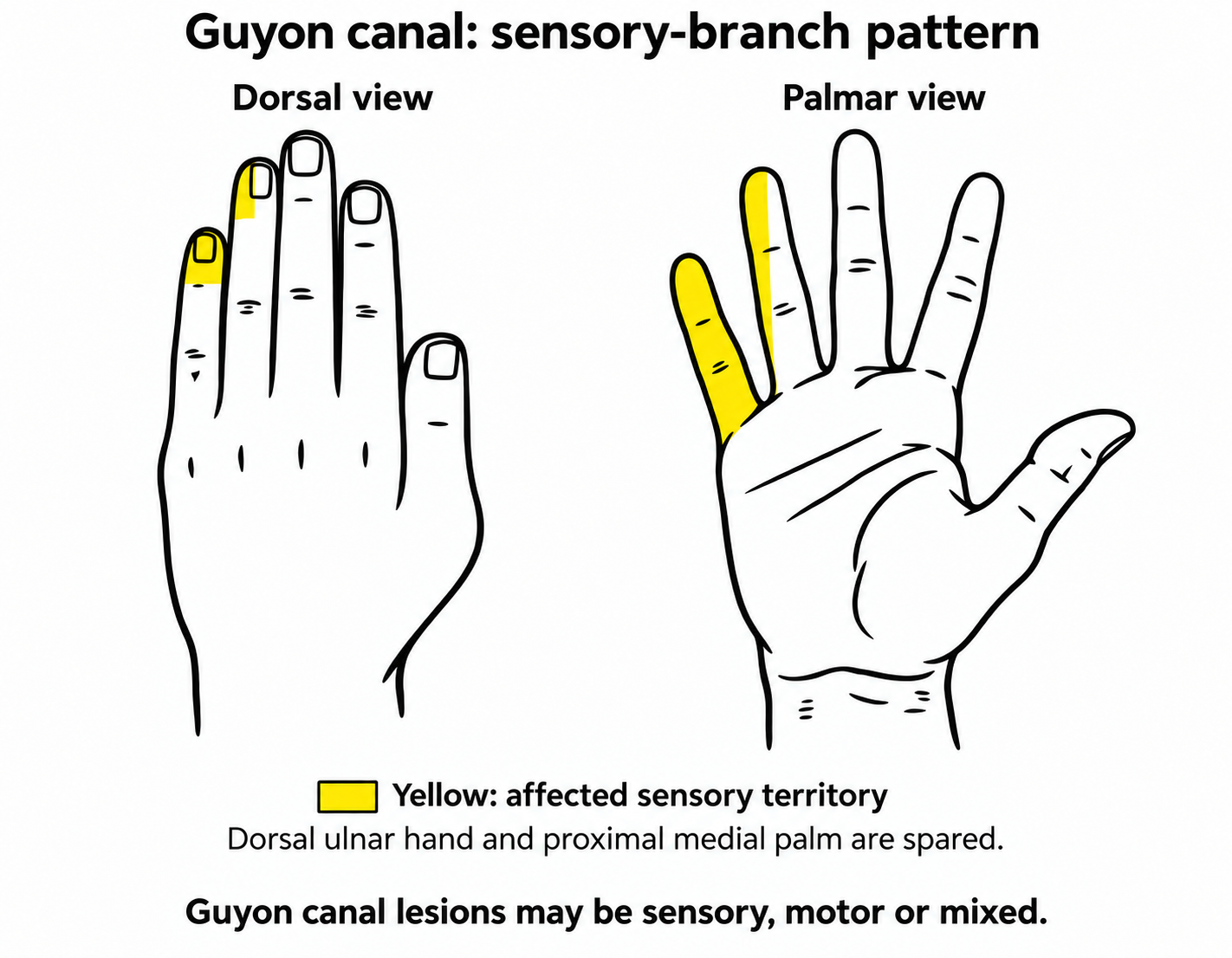 Guyon canal: sensory-branch pattern Sensory-branch Guyon canal pattern: palmar little finger and ulnar half of the ring finger, with distal dorsal fingertips affected; dorsal hand and palm spared