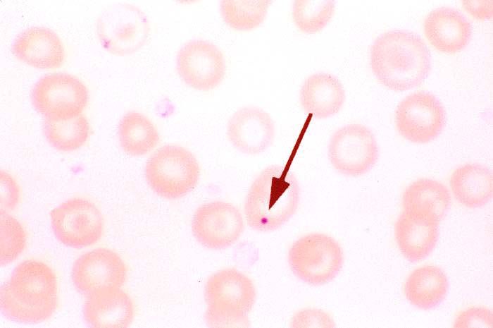 Howell Jolly Bodies Blood Film SimpleMed
