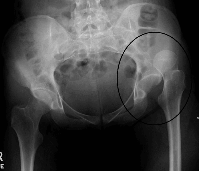 Hip Dislocation X-ray SimpleMed