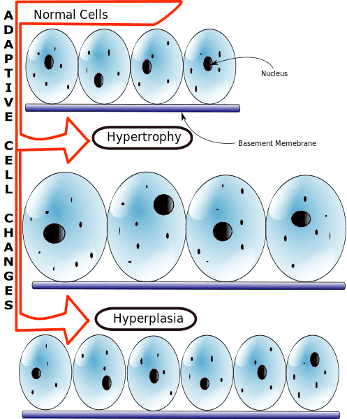 Differences Between Hyperplasia and Hypertrophy SimpleMed