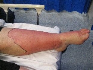 Cellulitis SimpleMed