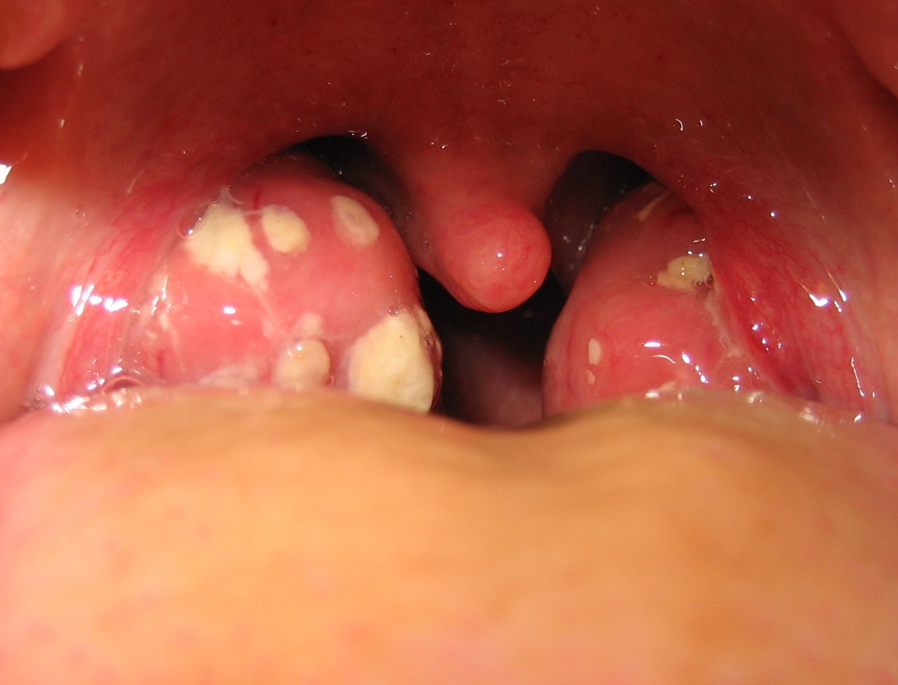 Inflamed Palatine Tonsils (Tonsillitis) SimpleMed