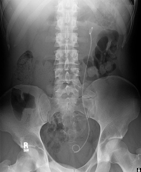 JJ Stent Abdominal X-ray SimpleMed