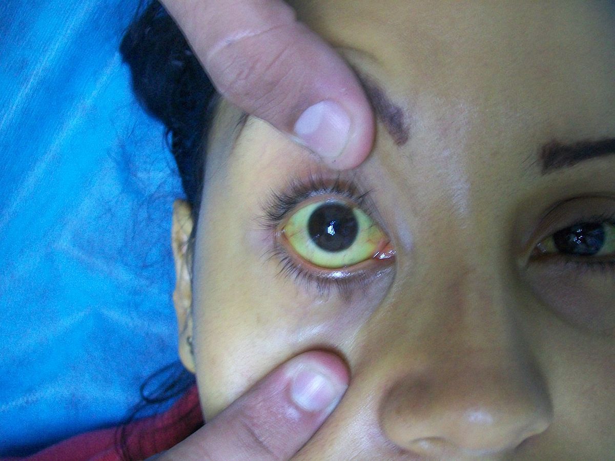 Jaundice of the Sclera SimpleMed