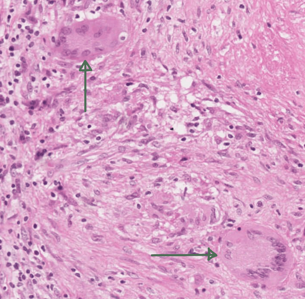 Langhans Giant Cells in TB Granuloma SimpleMed