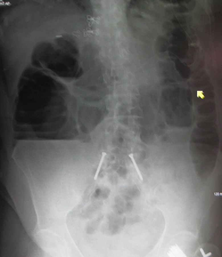 Large Bowel Obstruction Abdominal X-ray SimpleMed Large Bowel Obstruction Abdominal X-ray SimpleMed