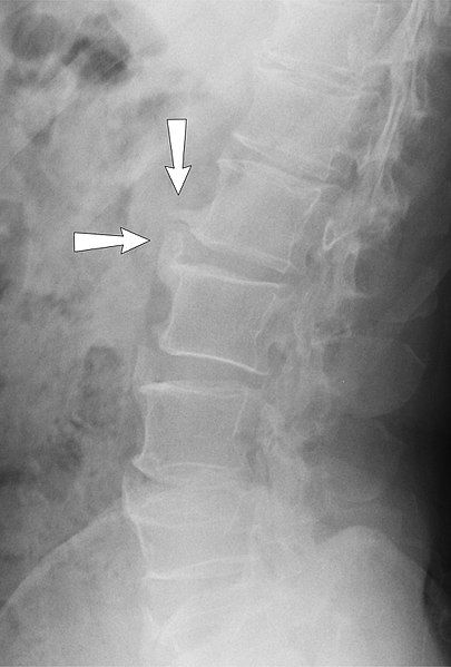 X-ray of Lumbar Spine Spondylosis SimpleMed