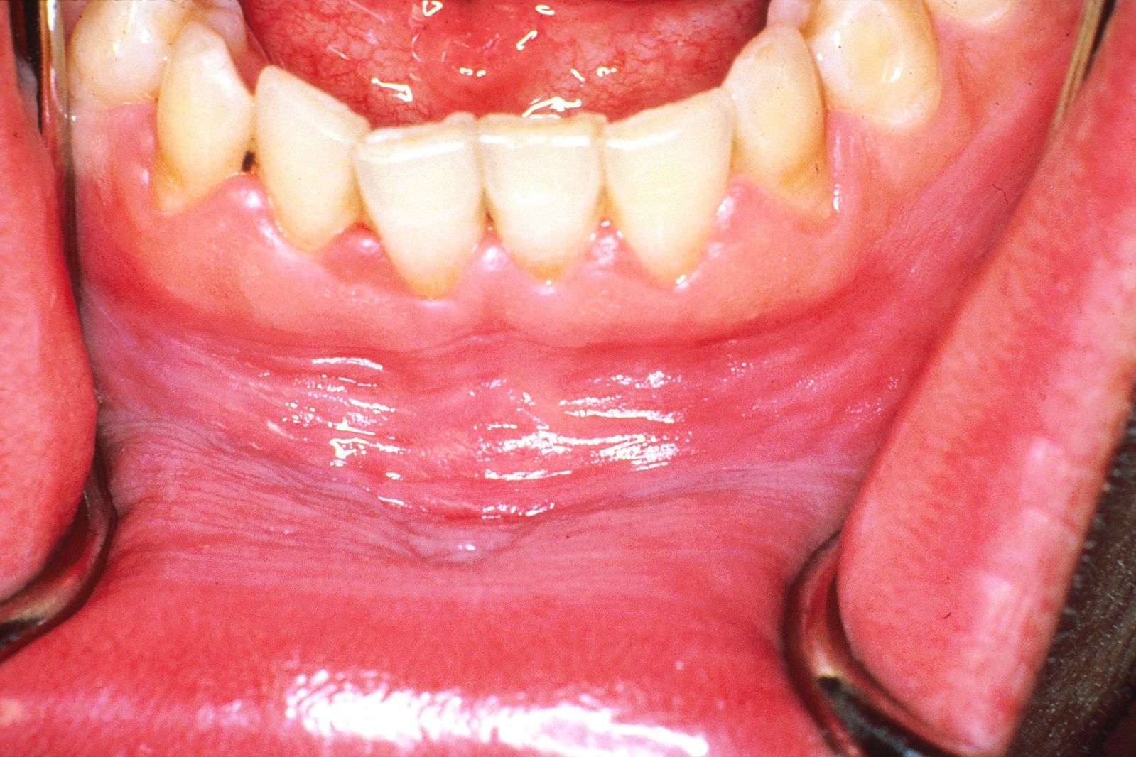 Leukoplakia of Lower Lip and Gum SimpleMed