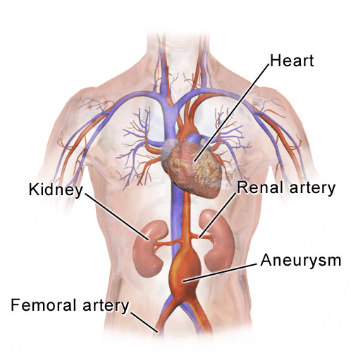 Location of Abdominal Aortic Aneurysm SimpleMed Location of Abdominal Aortic Aneurysm SimpleMed