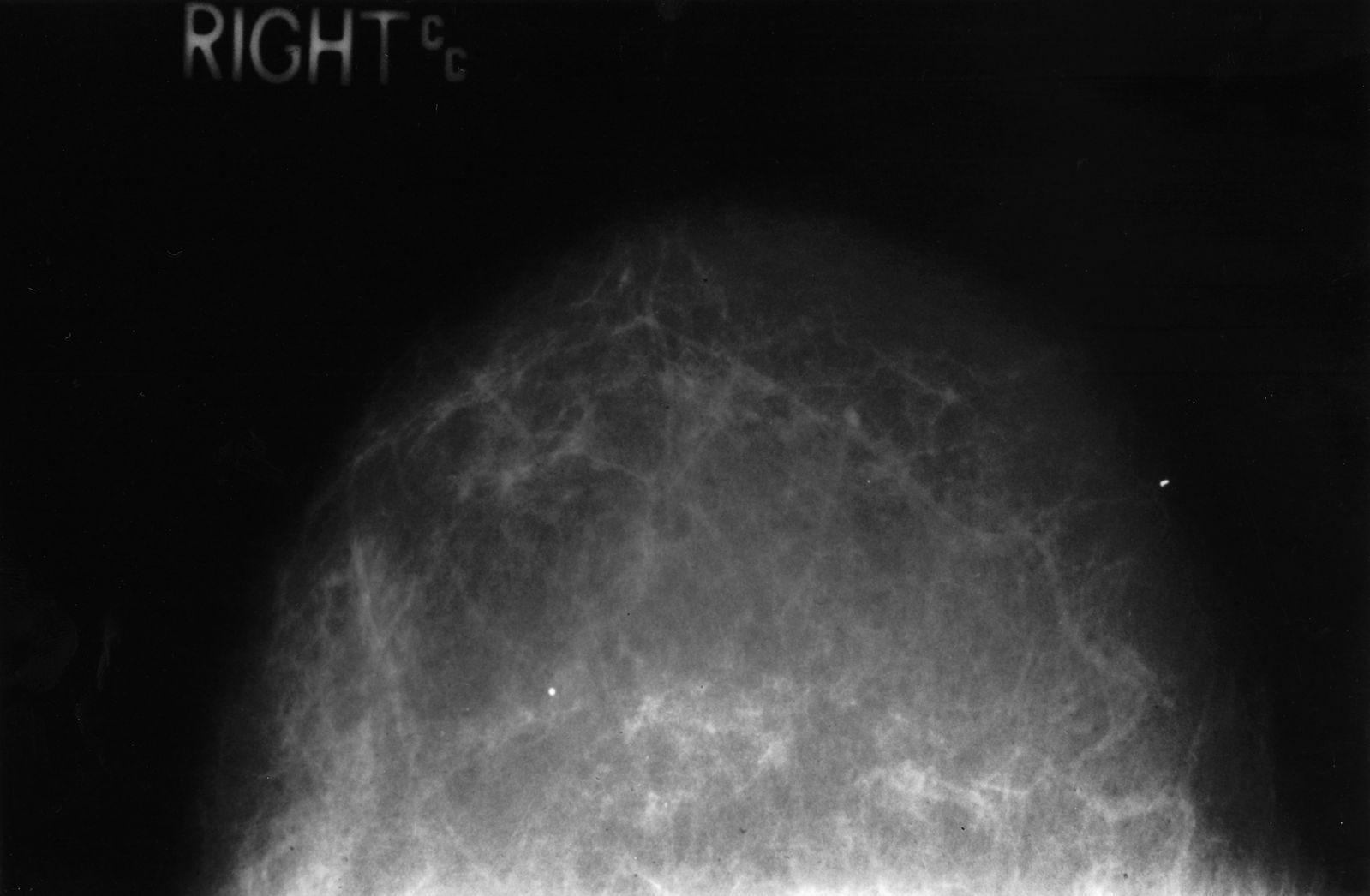 Mammogram of Normal Fatty Breast SimpleMed