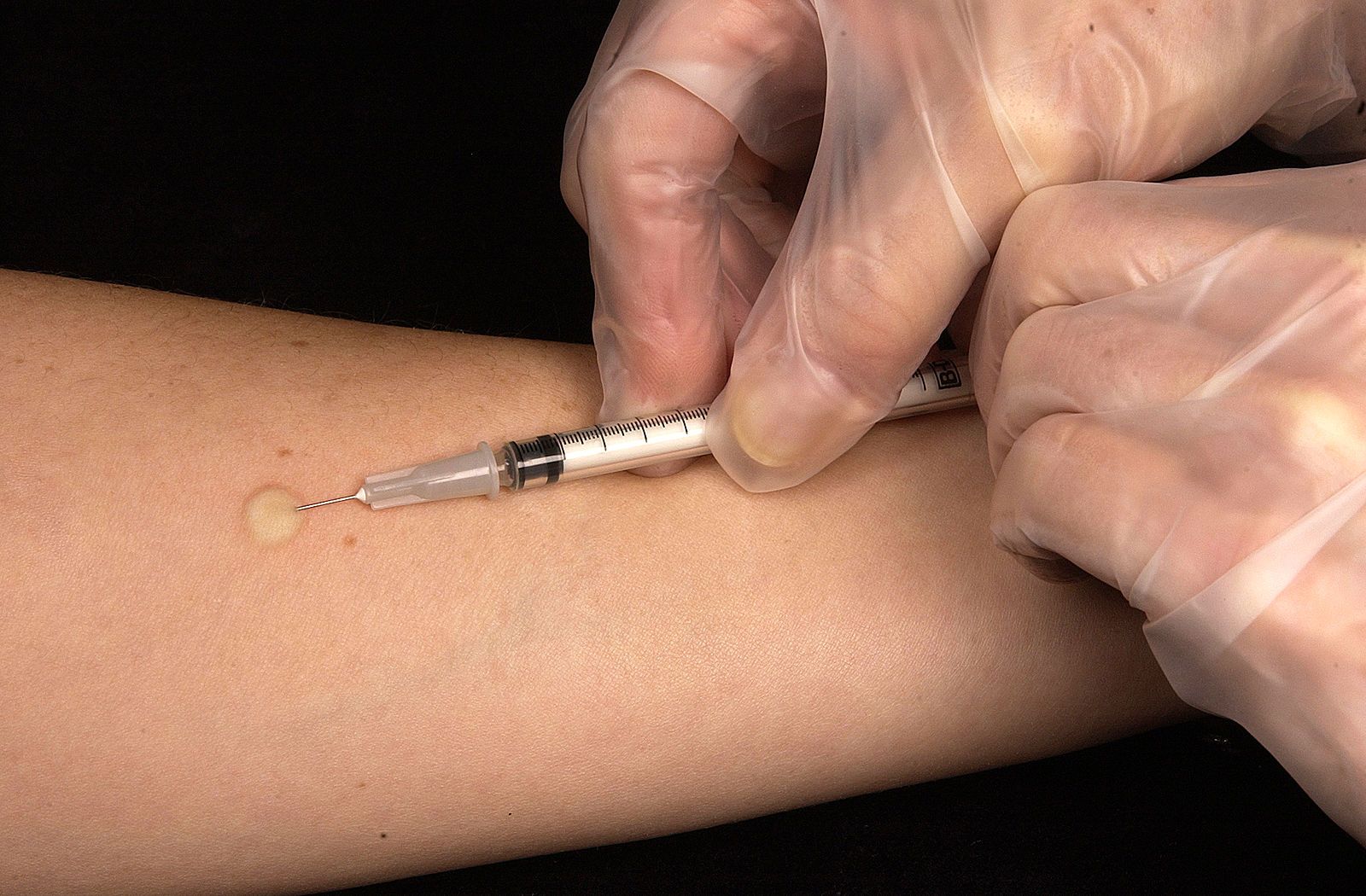 Administration of the Mantoux Tuberculin Skin Test SimpleMed
