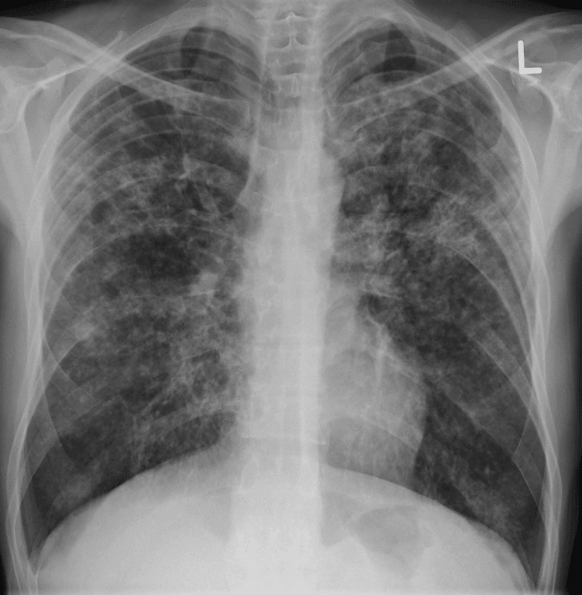 Miliary Tuberculosis Chest X-ray SimpleMed