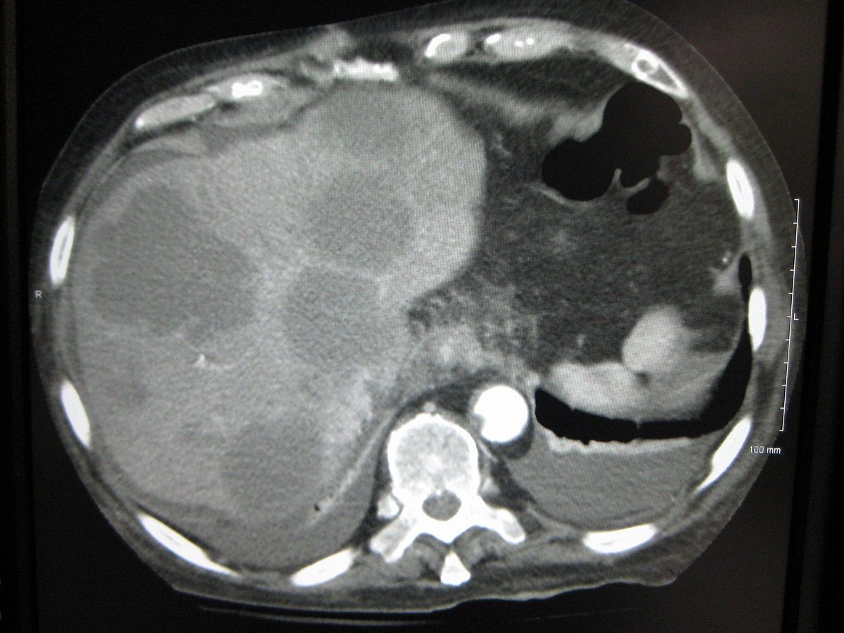 Multiple Liver Metastases on CT Scan SimpleMed
