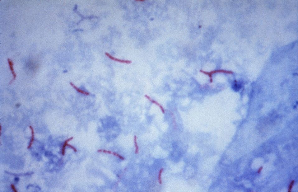 Mycobacterium Tuberculosis SimpleMed