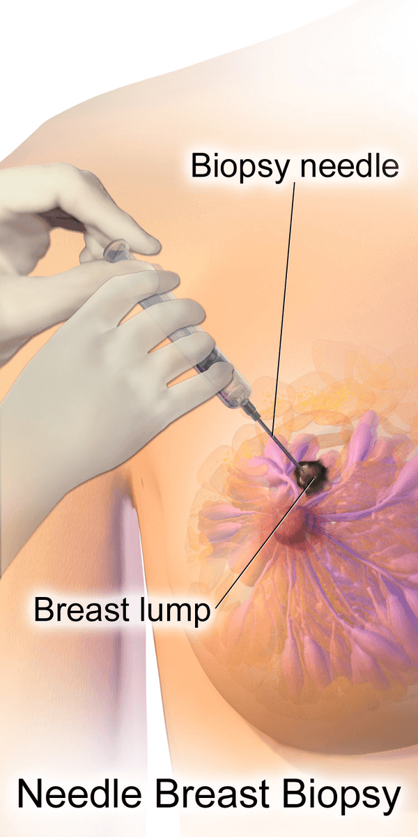 Needle Breast Biopsy SimpleMed