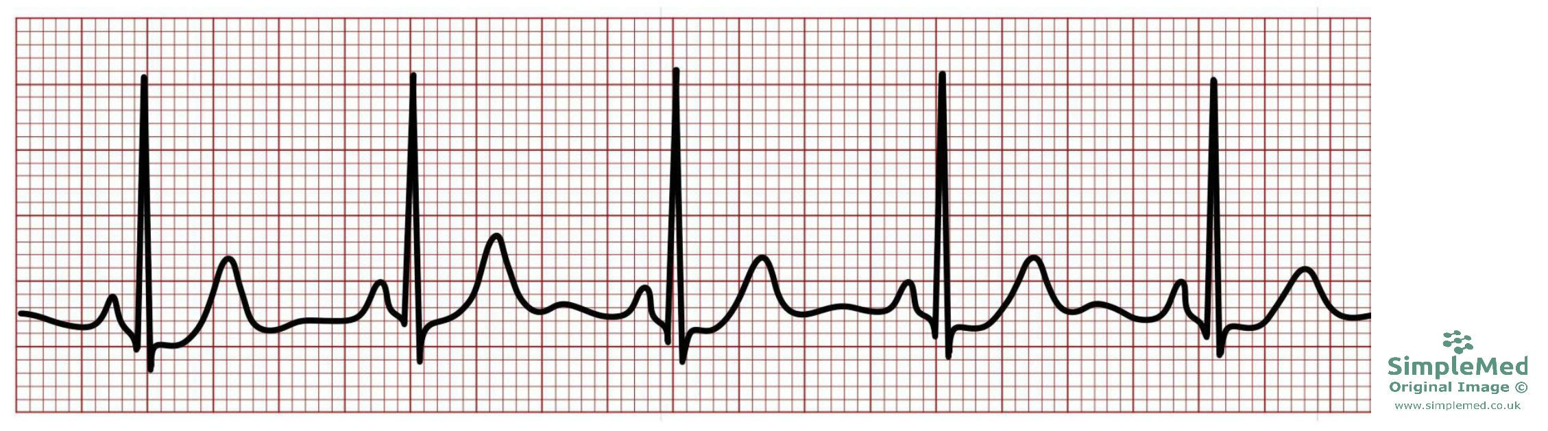 Normal Electrocardiogram ECG SimpleMed