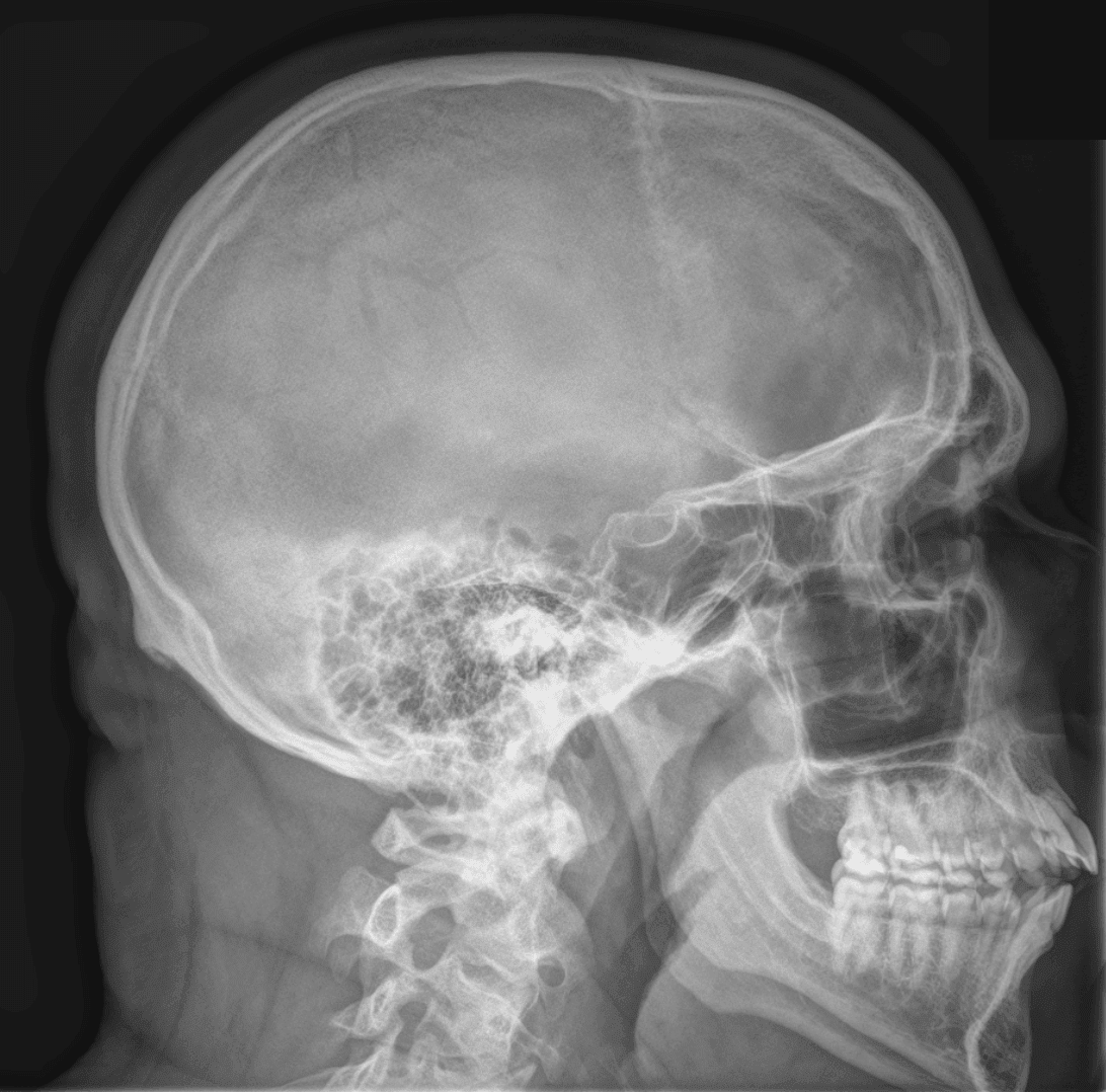 Normal Lateral Radiograph of the Skull SimpleMed