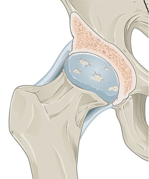 Osteoarthritis in the Hip SimpleMed
