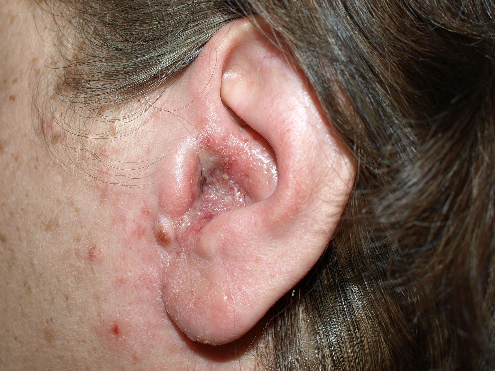 Otitis Externa SimpleMed Otitis Externa SimpleMed
