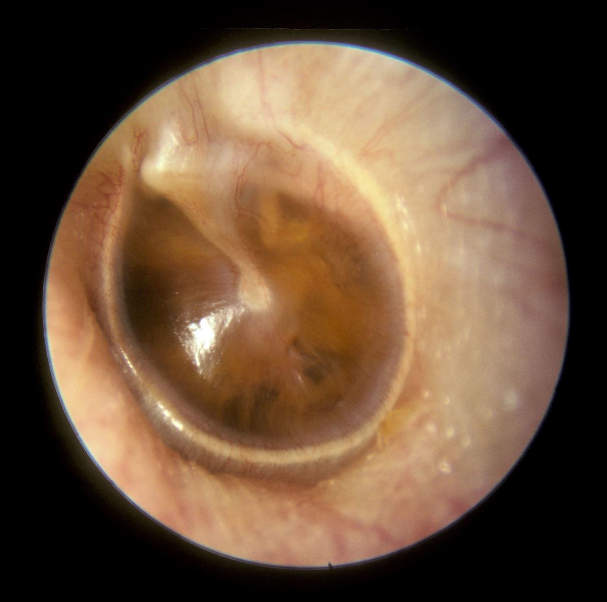 Otitis Media with Effusion SimpleMed Otitis Media with Effusion SimpleMed