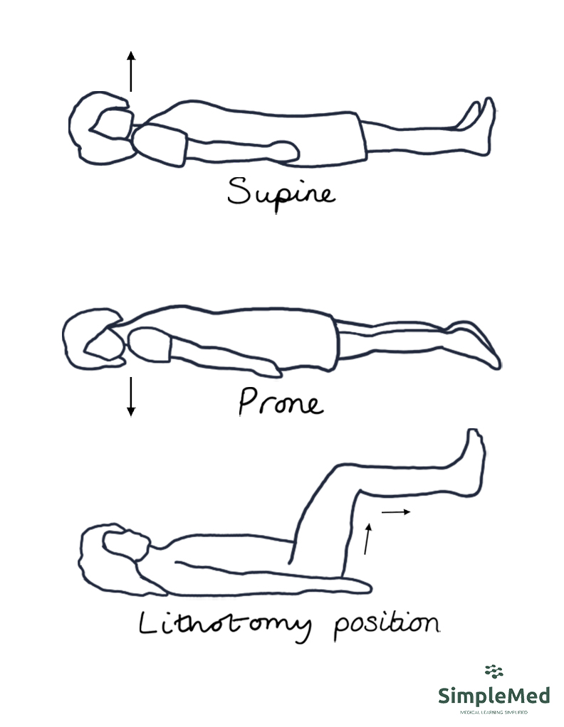 Patient positions: prone, supine and lithotomy position