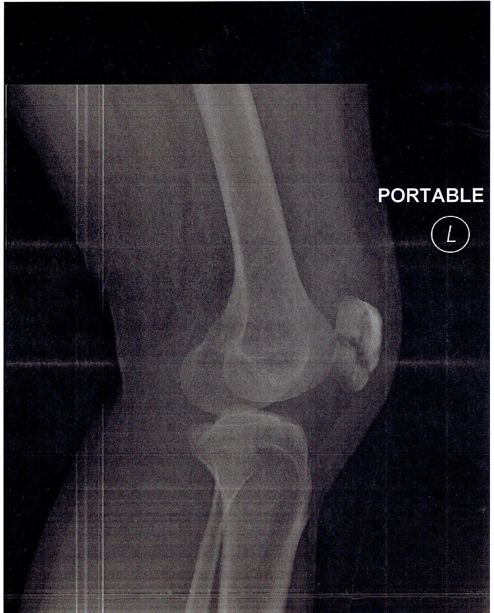 Patella Fracture SimpleMed