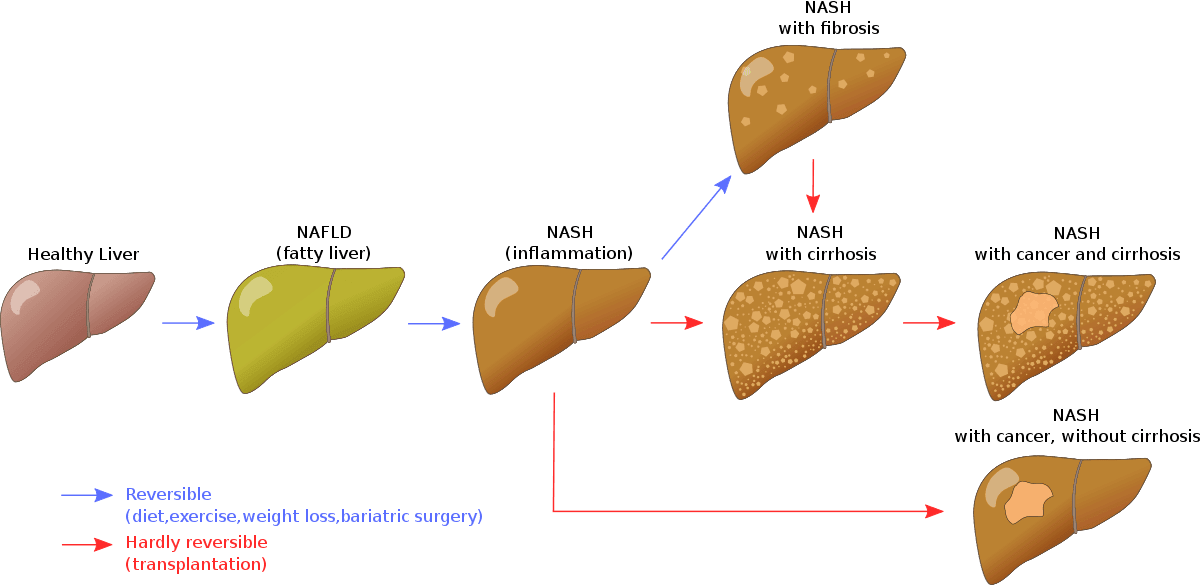 Progression of Non-Alcoholic Fatty Liver Disease (NAFLD) SimpleMed