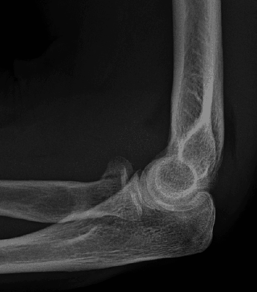 Radial Head Fracture X-Ray SimpleMed