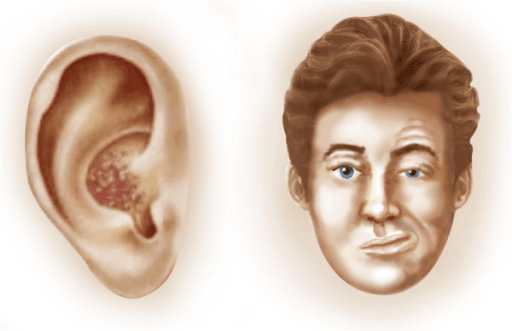 Ramsey Hunt Syndrome SimpleMed Ramsey Hunt Syndrome SimpleMed
