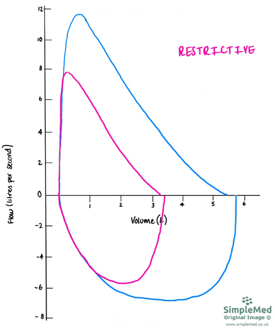 Restrictive Flow Volume Curve SimpleMed