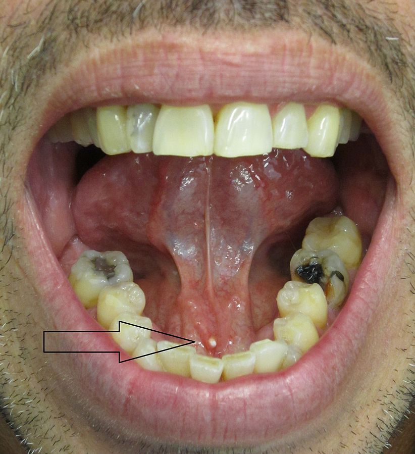 Salivary Stone in Submandibular Gland SimpleMed Salivary Stone in Submandibular Gland SimpleMed