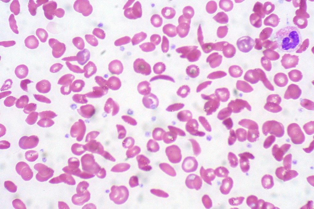 Sickle cell anaemia blood film SimpleMed