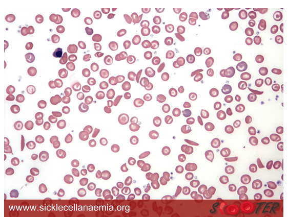 Sickle Cell Anaemia Blood Smear SimpleMed