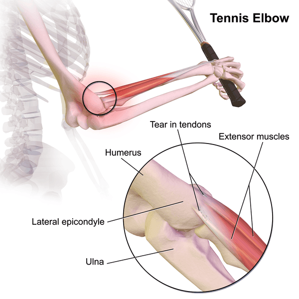 Tennis Elbow/Lateral Elbow Tendinopathy SimpleMed