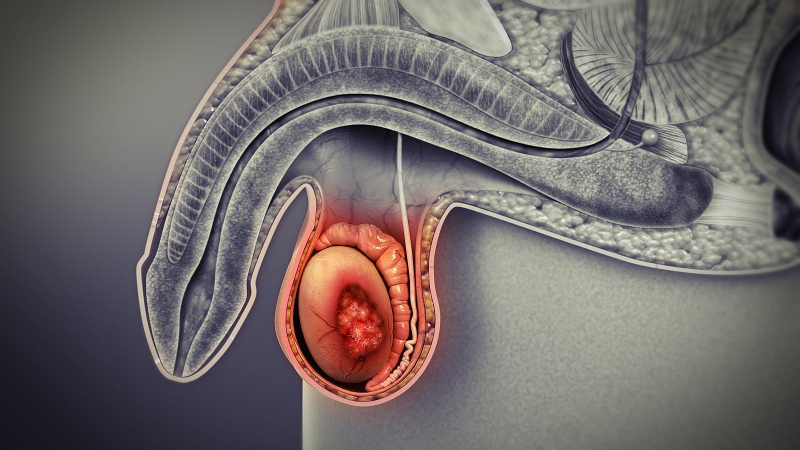 Testicular Cancer SimpleMed