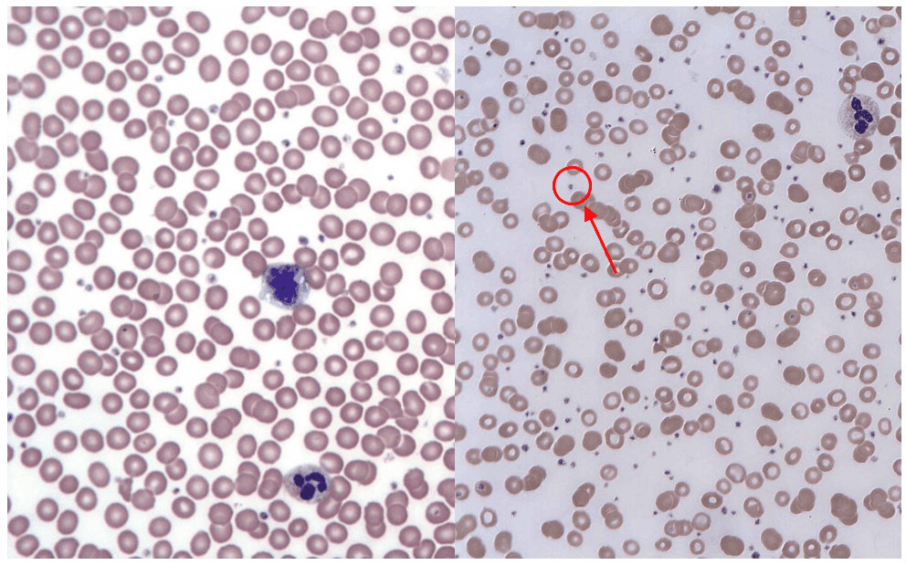 Thrombocytosis vs Normal Patient Blood Film SimpleMed