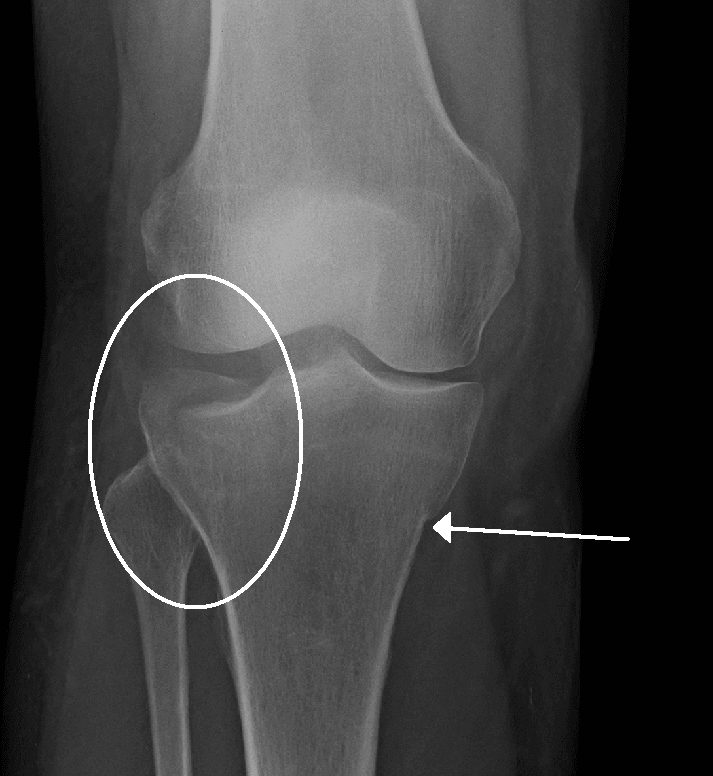 Tibial Plateau Fracture X-Ray SimpleMed