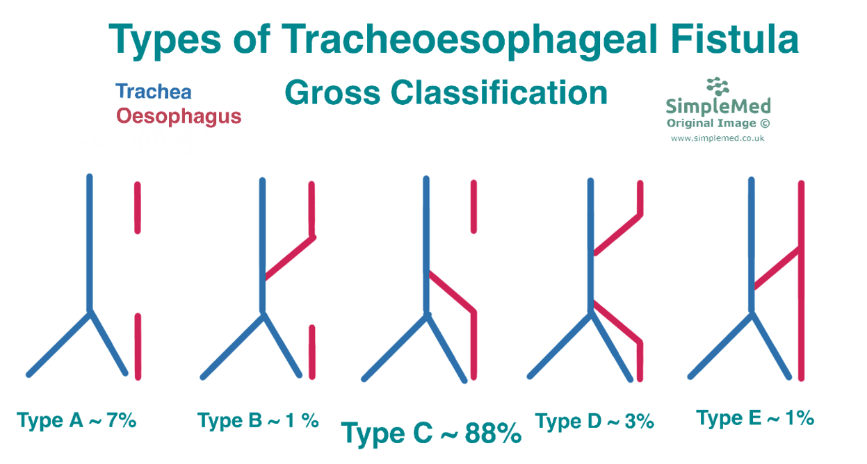 Types of Tracheoesophageal Fistula SimpleMed