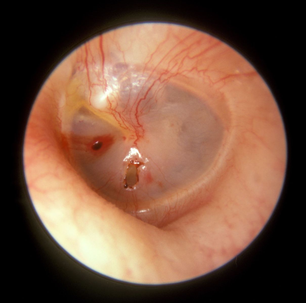 Traumatic Perforation of the Tympanic Membrane SimpleMed Traumatic Perforation of the Tympanic Membrane SimpleMed