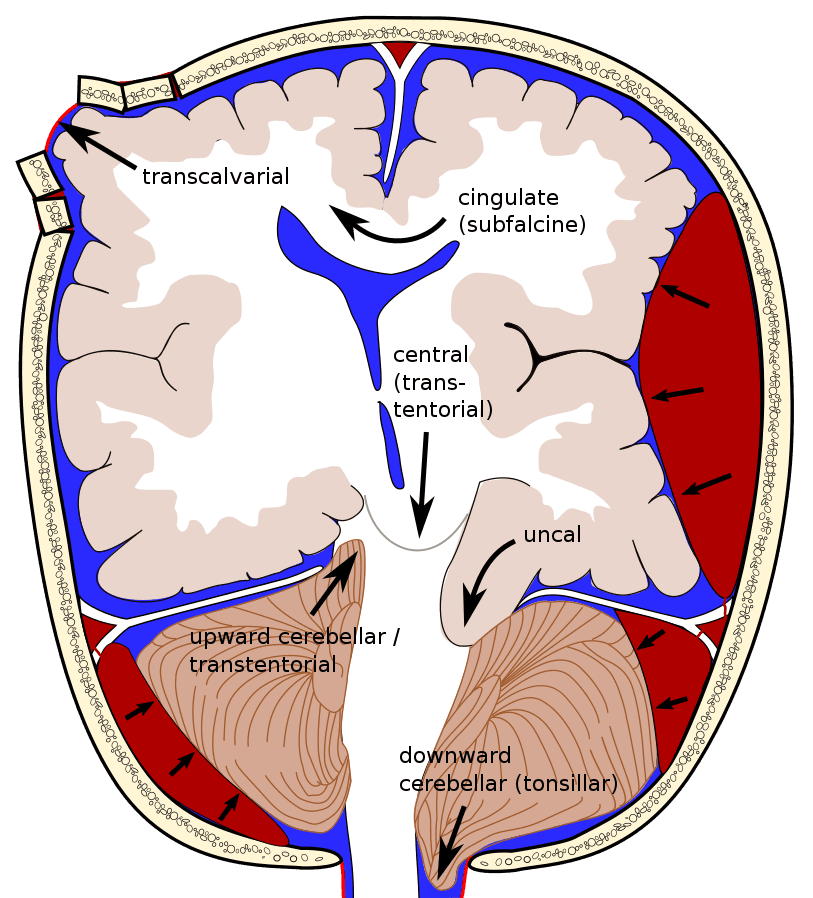 Types of Brain Herniation SimpleMed