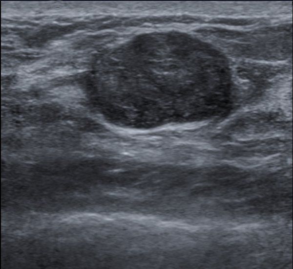 Ultrasound Image of Breast Fibroadenoma SimpleMed