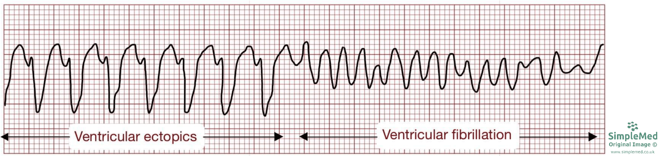 Ventricular Tachycardia ECG SimpleMed