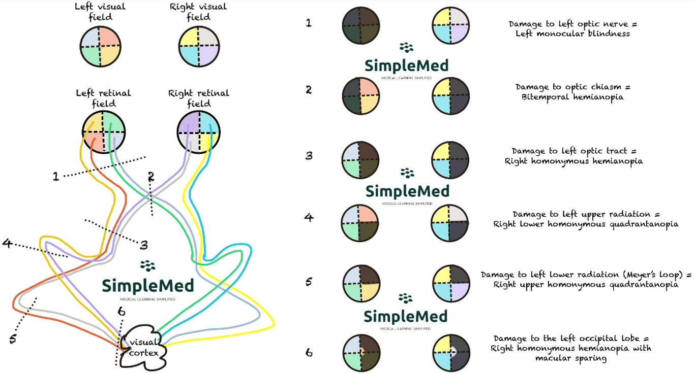 Visual Field Defects and Visual Field Pathway SimpleMed Visual Field Defects and Visual Field Pathway SimpleMed