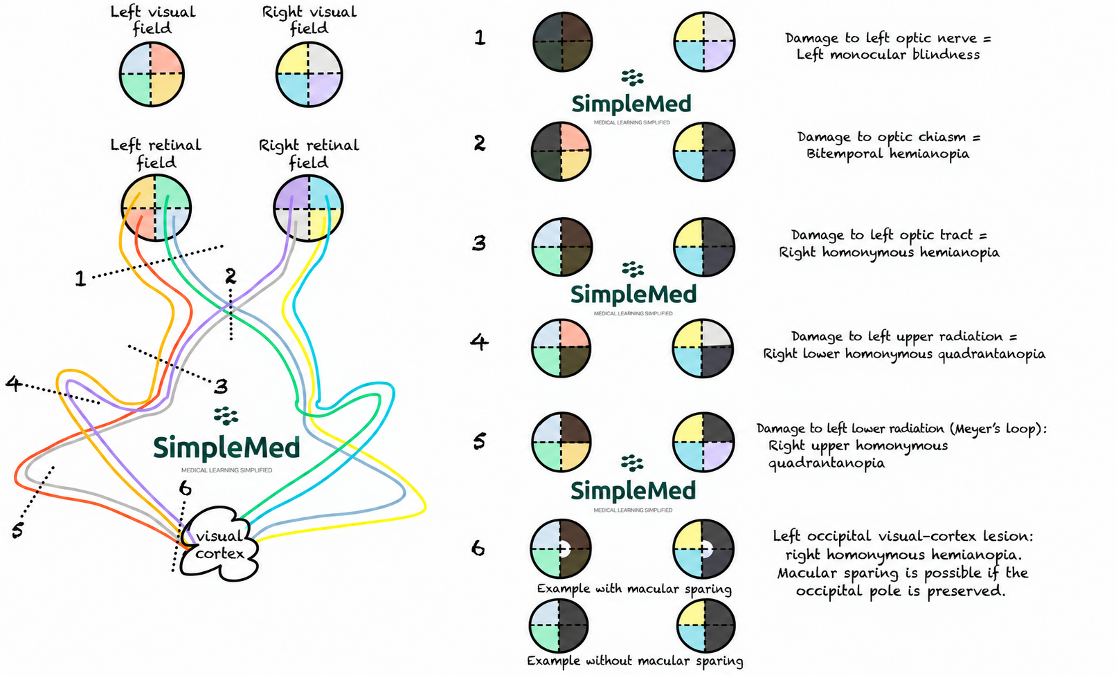 Schematic visual-field loss from left-sided visual-pathway lesions. Paired circles represent the left and right eyes; dark shading marks field loss. A left occipital lesion may cause right homonymous hemianopia with or without macular sparing.