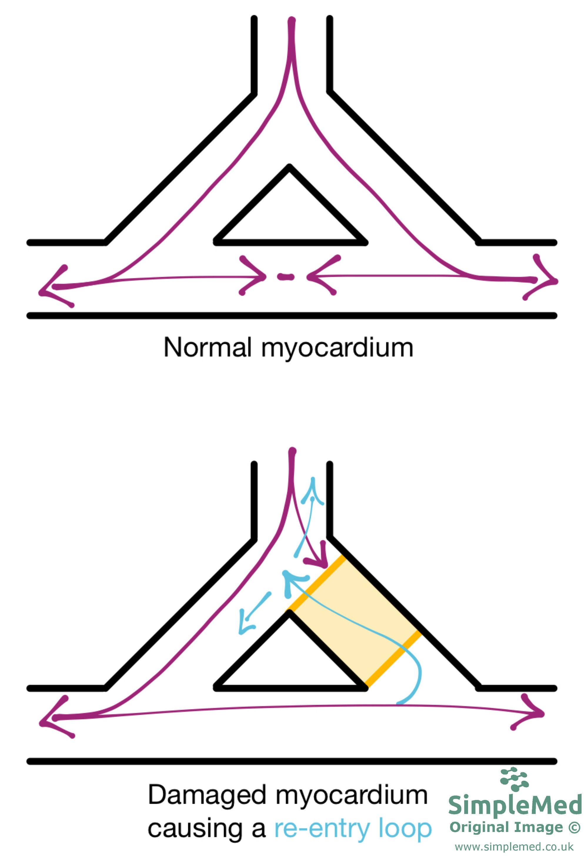 Re-Entry Loop in the Myocardium SimpleMed