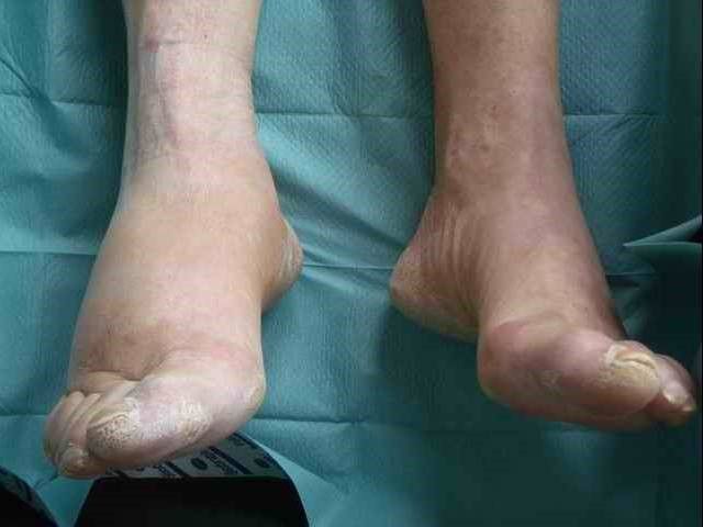 Charcot Arthropathy SimpleMed