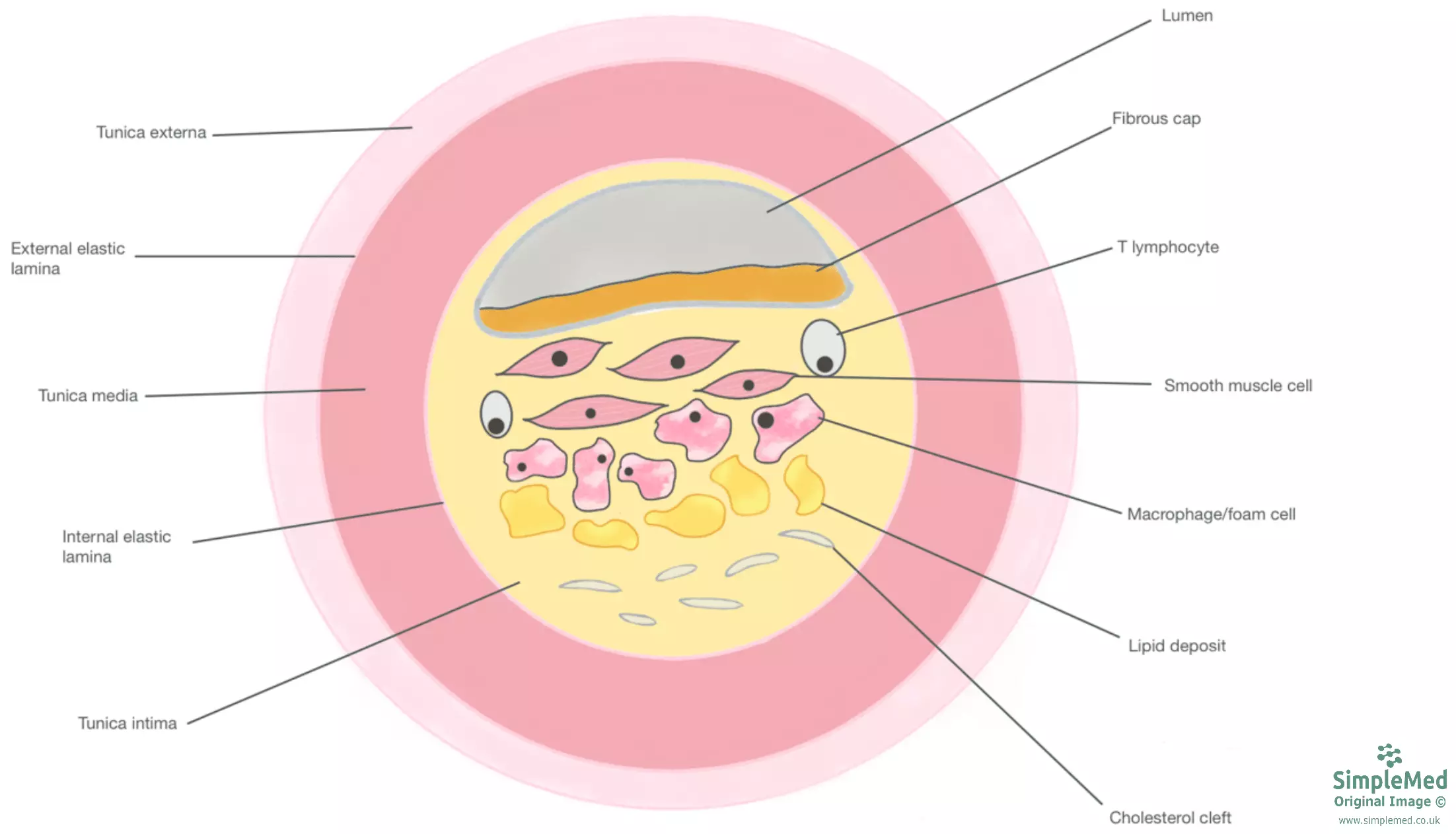 Atherosclerotic Plaque Diagram SimpleMed