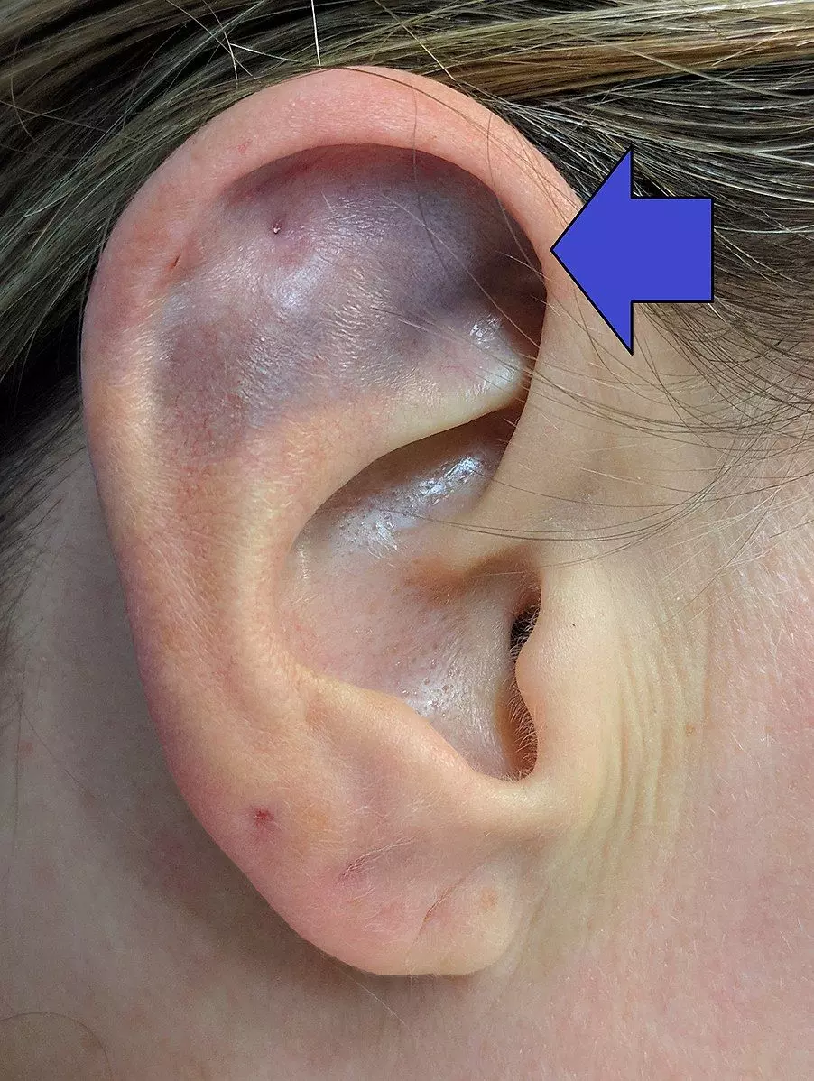 Pinna Haematoma SimpleMed