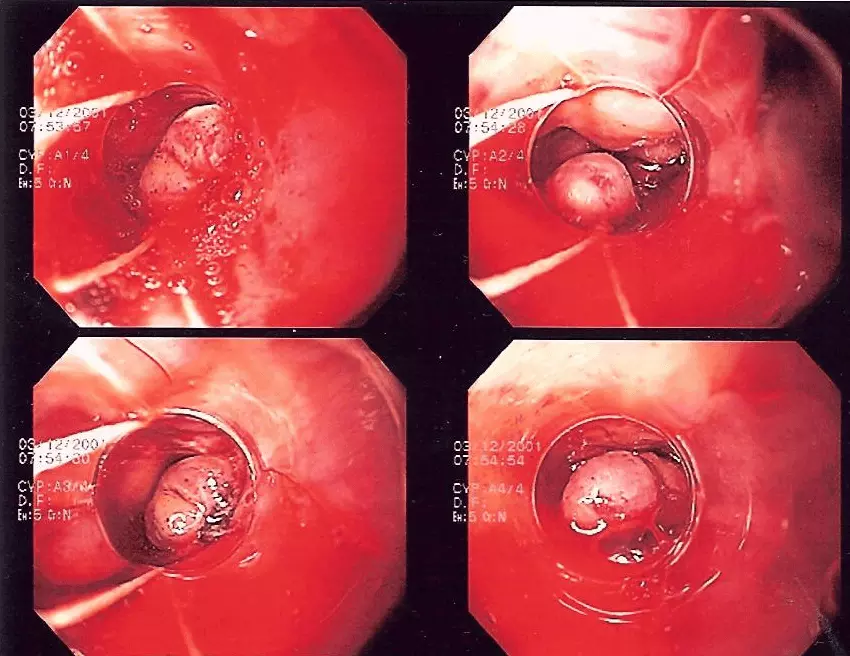 Band Ligation of Oesophageal Varices SimpleMed